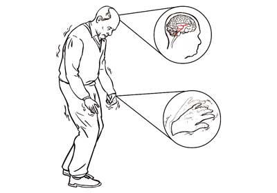 Ilustração de senhor mostrando tremores do Parkinson nas mãos e esquema mostrando degeneração cerebral causadora da doença