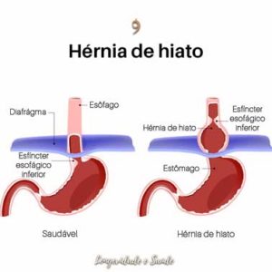 Diagrama demonstrando um estômago com hérnia de hiato e um normal tratamento para hérnia de hiato