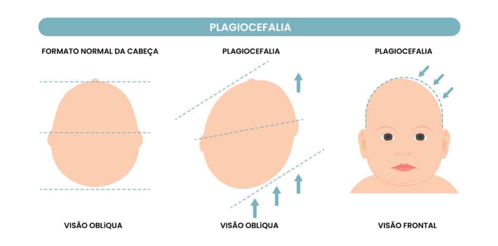 assimetria cranianas em bebes